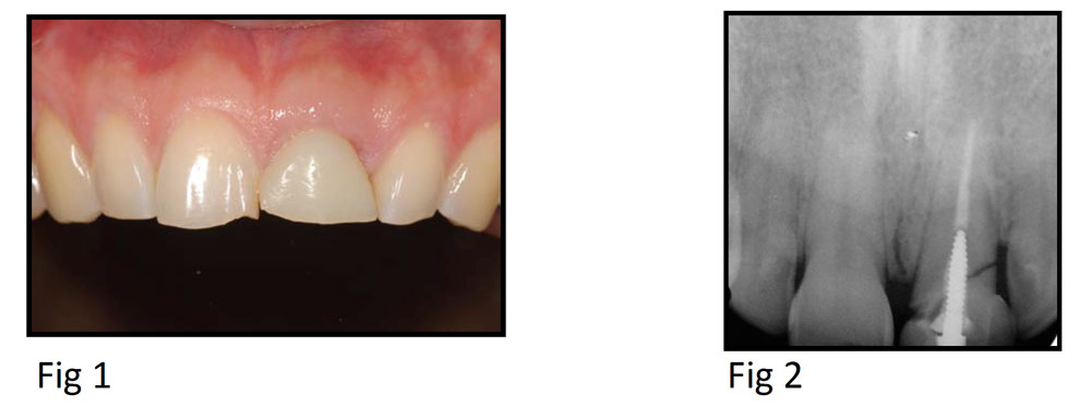 Using an Angled Screw for Retained Implant Restoration and Leveraging a HIPAA-Compliant Texting Solution to Enhance Referral, Planning, Coordination and Documentation